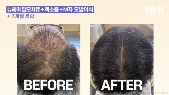 정수리탈모 엑소좀관리 7개월 경과 전후사진 관련 이미지 2