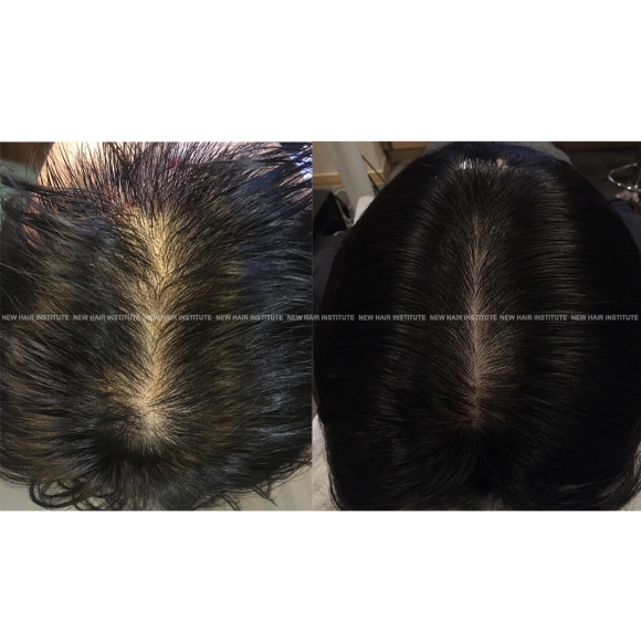 뉴헤어 탈모치료(모낭주사) 효과 l 엑소좀 강남탈모관리 관련 이미지 1