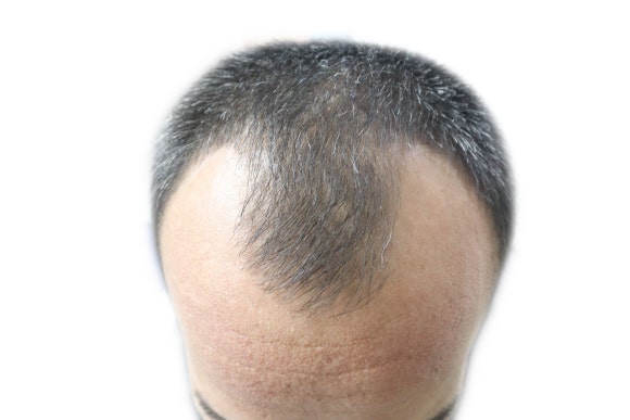 Androgenetic Alopecia (Hereditary Hair Loss): Epidemiological Features Seen Through the Latest U.S. Research image 1