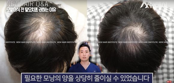 모발이식 알아봐야 한다면 관련 이미지 8