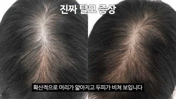 Hair Loss Test: If Your Crown Looks Like This, Go to the Hospital Right Away image 3