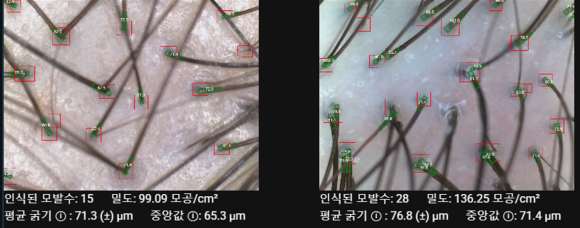 머리카락이 자꾸 끊어진다면 단순 손상일까 탈모 신호일까? 관련 이미지 3