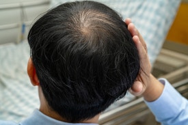 MZ세대 탈모 관리, 셀프 메디케이션? 가성비 치료방법? 관련 이미지 1