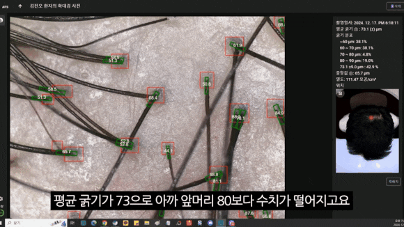 탈모검사, 치료 전 필수인 이유! 관련 이미지 5