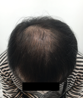 탈모치료주사? 효과 있을까 궁금하신 분들만 보세요 관련 이미지 5