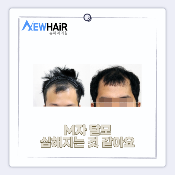 탈모초기증상 의심된다면? 관련 이미지 5