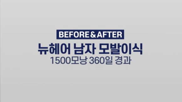 모발이식을 통한 엠자라인 극복 l 남자 이마축소 l 절개 모발이식 관련 이미지 1