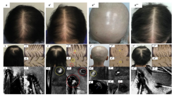 After Hair Loss from Cancer Treatment, Can It Grow Back? Predictive Factors Seen in Research image 2
