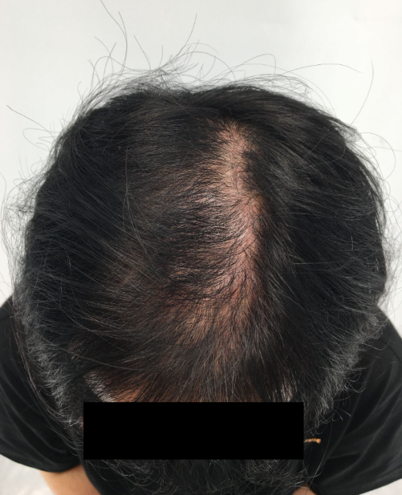 두피주사 6개월 맞고 보인 전후 모습 대공개 관련 이미지 3
