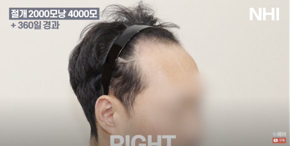 [뉴헤어] 남자 모발이식 2000모낭(4000모) 전후 비교 l 엠자이마 l 탈모 관련 이미지 4