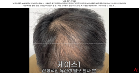 정수리탈모문신 시술직후 나타나는 효과?(전후사진) 관련 이미지 8