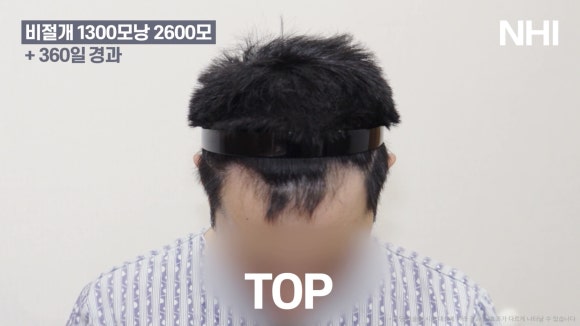 남자 앞머리 모발이식 l 탈모 모발이식 1년 전후 사진 관련 이미지 2