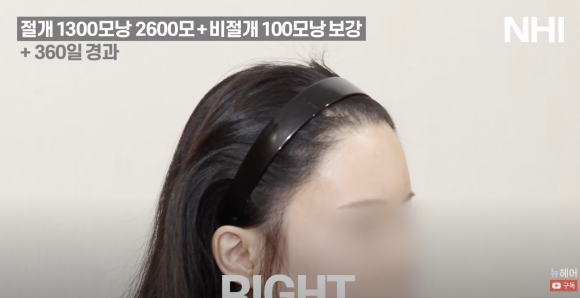 여자 모발이식 재수술 헤어라인교정 l  1300모낭 1년 경과 사진 l 3차 재수술 관련 이미지 4