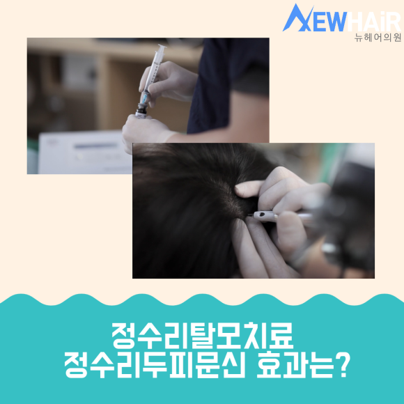 정수리두피문신 비용 고민이라면 관련 이미지 3