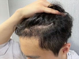 After a Hair Transplant, How Can You Return to Daily Life Without It Showing? image 3