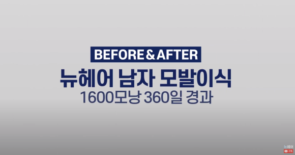 남자 모발이식 1600모낭 1년 지난 후 사진 경과 후기 관련 이미지 1