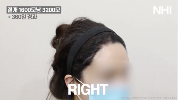 여자 모발이식을 통한 이마축소 l  1600모낭 전후사진 관련 이미지 5
