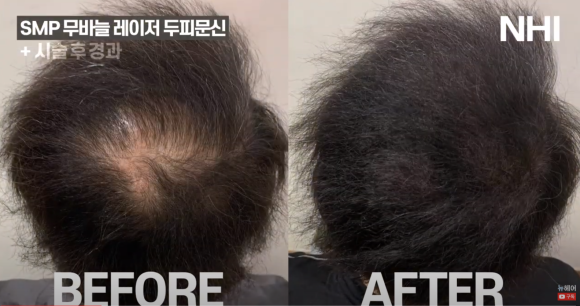 [뉴헤어] 두피문신 전후 빗질 영상 l 정수리 탈모 관련 이미지 2