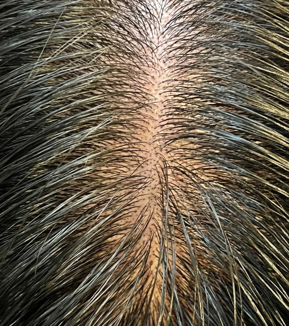 5 Cases When SMP Scalp Micropigmentation Is Needed image 2