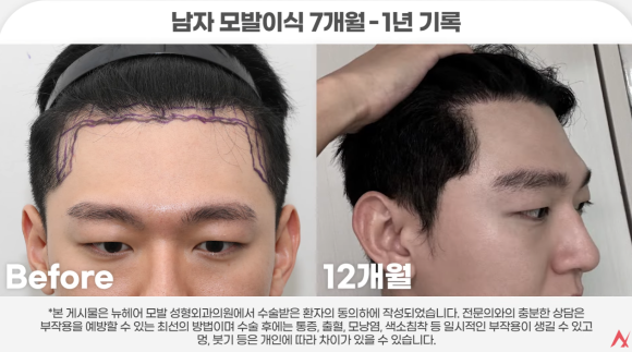 모발이식, 정말 해볼 만한가?(고민 중이라면 읽어야 할 글) 관련 이미지 3