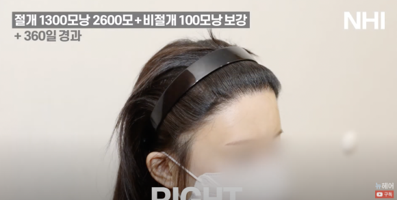여자 모발이식 재수술 헤어라인교정 l  1300모낭 1년 경과 사진 l 3차 재수술 관련 이미지 5