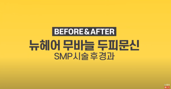 [뉴헤어] 두피문신 전후 빗질 영상 l 정수리 탈모 관련 이미지 1