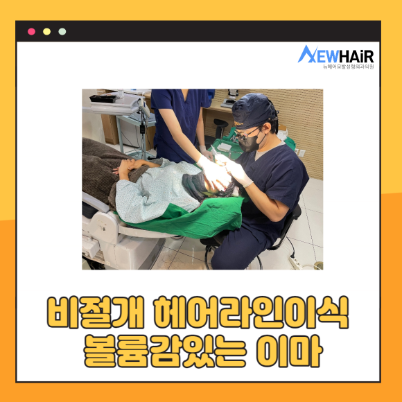 비절개 헤어라인이식으로 볼륨감있는 이마를 관련 이미지 1
