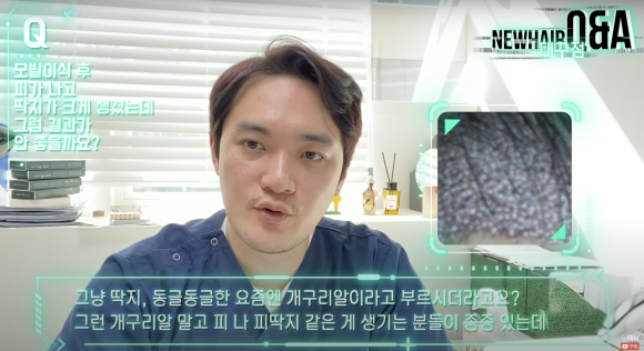모발이식 후 피 딱지, 모발이식 결과에 미치는 영향 #모발이식딱지 #개구리알 관련 이미지 1