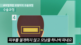 A Complete Guide to Non-Incisional Hair Transplant Methods image 8