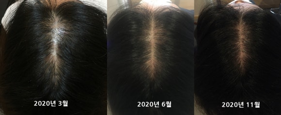 [탈모치료] 뉴헤어 탈모치료(엑소좀) 7개월 후기 관련 이미지 1