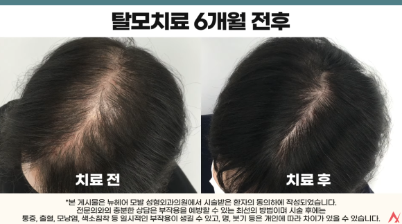 연예인들이 선택하는 탈모치료법? 가발에서 모발이식까지 관련 이미지 8