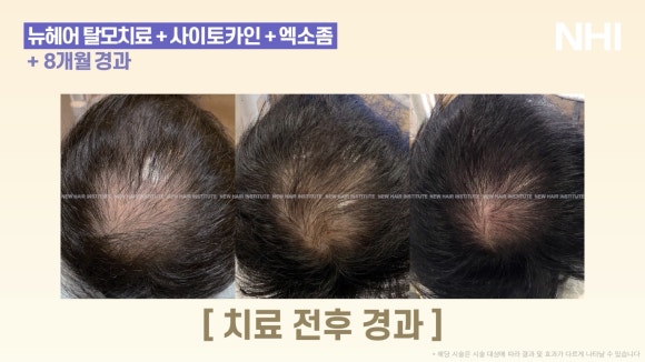 뉴헤어 탈모치료(모낭주사) 8개월 경과 사진 l 정수리탈모 관련 이미지 6