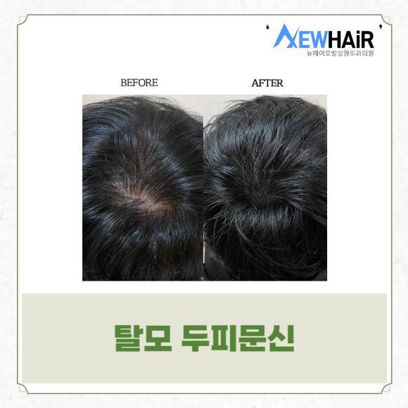 탈모문신으로 탈모 고민은 이제 그만 관련 이미지 4
