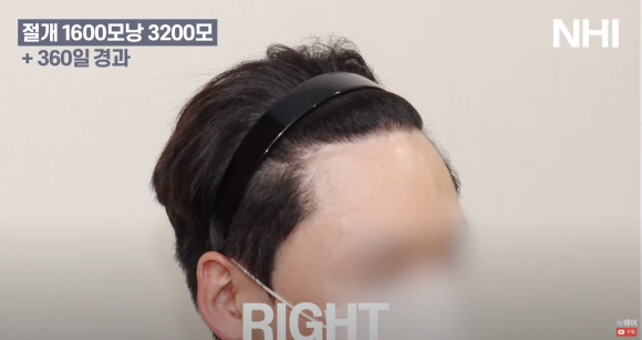 [뉴헤어] 남성 탈모 모발이식 1년 후 사진 공개합니다 관련 이미지 5