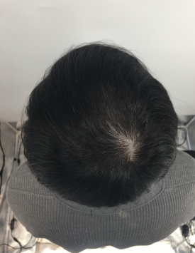탈모치료주사? 효과 있을까 궁금하신 분들만 보세요 관련 이미지 12