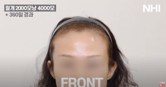여성 헤어라인교정 2000모낭 절개 1년 후 영상 후기 관련 이미지 2