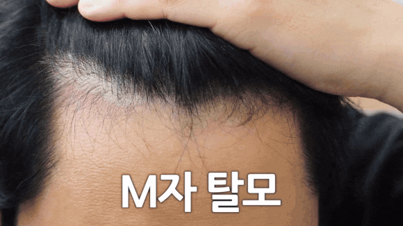 탈모치료방법, 비수술로 해결될까요? 관련 이미지 1