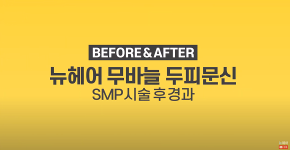 #정수리탈모 두피문신 전후사진 보기 관련 이미지 1