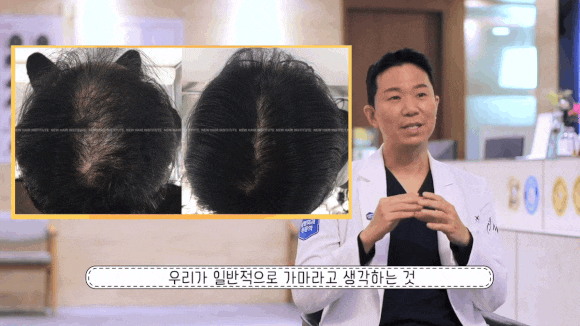 정수리 탈모, 방치했다면 회복이 늦어지는 이유 관련 이미지 3