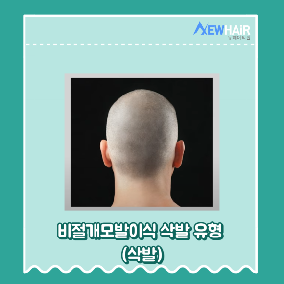 강남비절개모발이식 삭발 유형 알아보기(무삭발,부분삭발,삭발) 관련 이미지 7