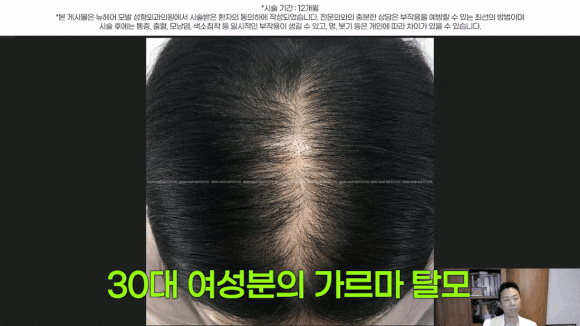 여자정수리탈모, 약 없이 치료하는 법 관련 이미지 5