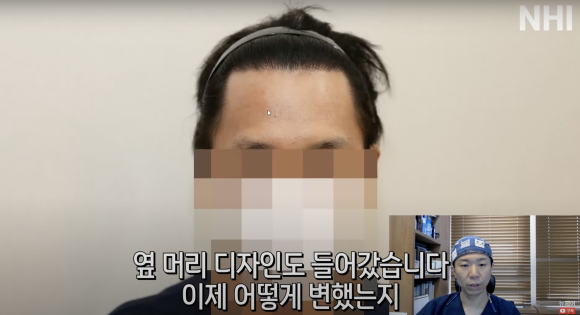 엠자탈모 모발이식 1년 후l 모발이식 후기 #높은이마 #고밀도이식 설명해드립니다 관련 이미지 3