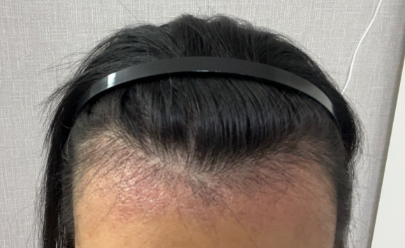 넓은이마 모발이식, 평생 유지되는 조건은 무엇일까? 관련 이미지 3