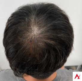 50대 남성 정수리 탈모, SMP 두피문신으로 극복하는 방법 관련 이미지 3