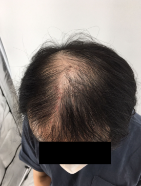 탈모치료주사? 효과 있을까 궁금하신 분들만 보세요 관련 이미지 7