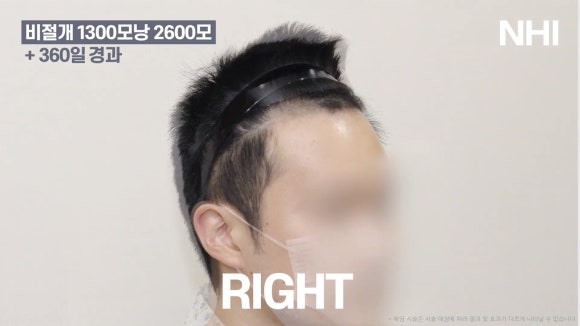 남자 앞머리 모발이식 l 탈모 모발이식 1년 전후 사진 관련 이미지 6