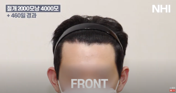 [뉴헤어] 남자 모발이식 후기 2000모낭 심고 460일 지났습니다 관련 이미지 2