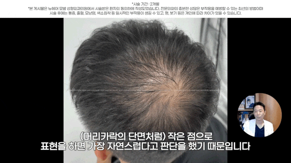 정수리탈모문신 시술직후 나타나는 효과?(전후사진) 관련 이미지 21