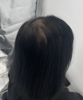 모발문신후기? 탈모치료와 병행한 40대 여성 환자분 사례 관련 이미지 7