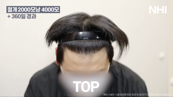M자탈모(엠자탈모) 모발이식 1년 후 모습 공개 l 2000모낭(4000모) 관련 이미지 7